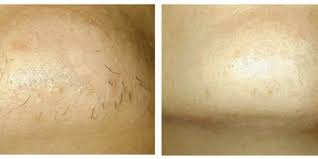 We live in a world where technology runs everything, and luckily, facial hair removal has been made a lot easier by the tommy timmy smoother skin hair removal laser.this amazing device uses laser technology that emits rapid light pulses. How To Remove Female Chin HairØªÚ¾ÙˆÚ'ÛŒ Ø³Û' Ø¨Ø§Ù„ Ø®ØªÙ… Ú©Ø±Ù†Û' Ú©ÛŒÙ„Ø¦Û'