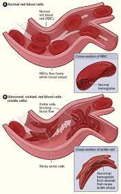 Sickle cell disease can cause a wide range of symptoms. Sickle Cell Anaemia Medical Articles Service Medicine Aqua Med