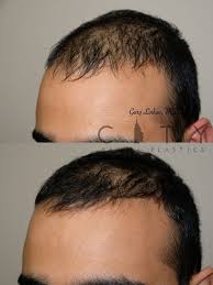 The treatment was repeated every two weeks, for a total of four times. Nyc Prp For Hair Loss New York Cosmetic Plastic Surgery Ues