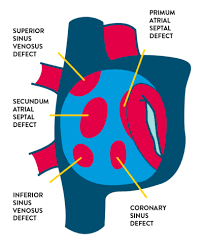 Atrial Septal Defect Abbott