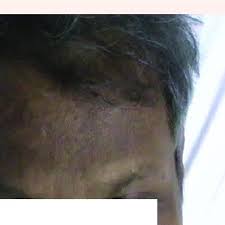 Search for matted black hair with addresses, phone numbers, reviews, ratings and photos on nigeria business directory. Darkening Of The Skin Of The Forehead With Brittle Matted Hair Download Scientific Diagram
