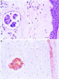 Surgeon was 99% sure it was not cancer recurrence; Persistent E Cadherin Expression In Inflammatory Breast Cancer Modern Pathology