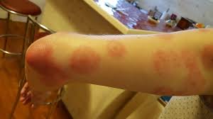 piqures et boutons de punaises de lit comment les reconnaitre