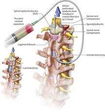 Image result for Spinal Epidural Abscess
