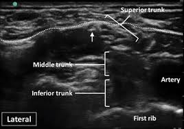 Image result for Superior Trunk Block