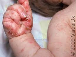 Image result for scabies human children