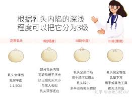 乳头内陷可以自己揪出来吗？ - 知乎