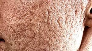 Cicatrices De Acne Tratamiento Eliminacion Los Mejores Tratamientos
