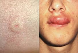 It's important not to harm bumble bees as their population is endangered, and plants and food depend on bumblebees to thrive. Bee Wasp Sting Treatment Remedy Relief For Swelling Reaction