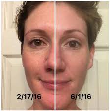 I had terrible acne and I was so self-conscious about it that I wouldn't  even look at myself in the mirror. I hated my skin and felt like everyone  was staring at