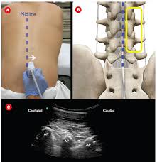 Traditionally lumbar puncture (lp) is performed in the lateral decubitus position. How To Perform An Ultrasound Assisted Lumbar Puncture Acep Now