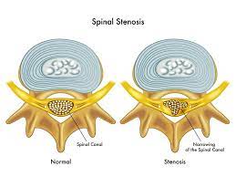 Spinal Stenosis Center Lumbar Cervical Symptoms Exercise Surgery