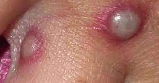 Jun 10, 2021 · richard firth, consultant in health protection at public health wales, told the sun: What Is Monkeypox Viral Zoonotic Disease Found In Uk Wales Online