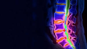 Oft befürchtet, aber in den meisten fällen nicht nötig: Diagnose Und Therapien Bandscheibenvorfall Geduld Geht Vor Op Rbb