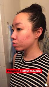 Thoa dầu dừa lên da trong 1 tuần để chữa sẹo mụn, cô nàng này đã nhận được  kết quả đáng thất vọng