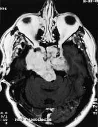 Bone cancer survival rate depends upon various factors like age, overall physical health, stage (how far the cancer has spread) when the cancer is detected, how long the patient has had the symptoms, type of treatment received and how strong the patient is, to withstand the treatment. A Multidisciplinary Team Approach To Skull Base Chordomas In Journal Of Neurosurgery Volume 95 Issue 2 2001
