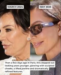 Kris Kardashian Operation