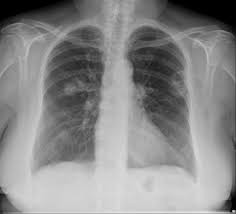 Synchronous Lung Cancers Radiology Case Radiopaedia Org