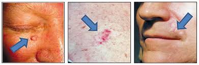Skin Cancer To Each Tumor Its Particulariti Eurekalert