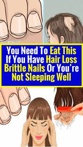 14 enemies of weight loss and how to conquer them. If You Have Hair Loss Or You Are Not Sleeping Brittle Nails Thebestoilforhairloss Hairloss In 2020 Postpartum Hair Loss Remedies Why Hair Loss Estrogen Hair Loss