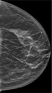 What does breast dcis look like. Tomosynthesis Better Long Term Than Digital Mammography For Breast Cancer Screening