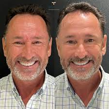 Olha só como era o sorriso do Raul e como está agora! ✨😊✨ O Raul juntou-se  ao Dr. Euriberto Santana, e após um minucioso trabalho de confecção e  planejamento, produziu esse resultado