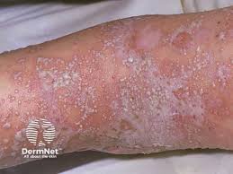 Image result for Pustular Psoriasis