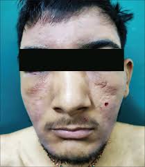 It can be difficult to treat and may require a while both diagnosis and treatment of morbihan syndrome can be challenging, better outcomes can. Indian Journal Of Dermatology Venereology And Leprology Morbihan Disease Look Beyond Facial Lymphedema