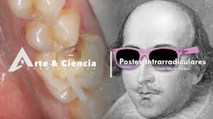 ►Postes Intrarradiculares