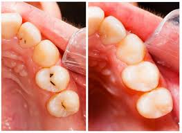 Fortunately, there are simple ways to keep teeth strong and healthy from childhood to old age. Ceramic Fillings Are The Best For Your Teeth Columbus Oh