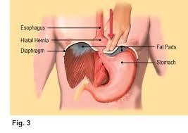 You'll drink small amounts of water with the tube in place to measure your ability to swallow. Hiatal Hernia Acid Reflux And Gerd