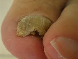 The Truth About Thickened Toenails Sutherland Podiatry
