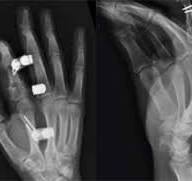 External Fixation System | Acumed