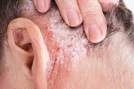 Normally, the immune system can tell the difference between your cells and foreign cells, like bacteria. Is Thyroid Endocrinopathy Associated With Psoriasis