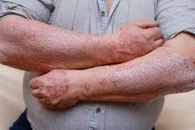 Image result for psoriasis