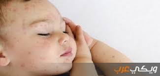 Maybe you would like to learn more about one of these? Ø¹Ù„Ø§Ø¬ Ø§Ù„Ø¹Ù†Ù‚Ø² Ø¹Ù†Ø¯ Ø§Ù„Ø£Ø·ÙØ§Ù„ ÙˆÙŠÙƒÙŠ Ø¹Ø±Ø¨