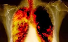 Kanser hanya berada dalam koloninya dibahagian paru paru. 9 Tanda Tanda Anda Mungkin Hidap Kanser Paru Paru Iluminasi