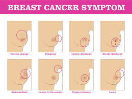 Breast cancer is an uncontrolled growth of cells that starts in the breast tissue. Breast Cancer The Most Common Kind Of Cancer In Women