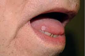 Image result for papillomavirus tongue)
