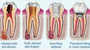 Patients generally need a root canal when they notice their teeth are sensitive, particularly to hot and cold sensations. When Do You Need A Root Canal College Plaza Dental Associates