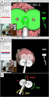 Invesalius generates 3d medical imaging reconstructions based on a sequence of 2d dicom files acquired with ct or mri equipments. Development And Characterization Of The Invesalius Navigator Software For Navigated Transcranial Magnetic Stimulation Sciencedirect