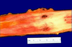 Webmd looks at the causes and treatments of esophagitis, an inflammation of the esophagus. Gastrointestinal Pathology
