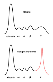 Multiple myeloma is an uncommon lymphoproliferative disease in animals, accounting for less than 8% of all hematopoietic serum and urine samples can be submitted for parallel protein electrophoresis. Multiple Myeloma Amboss
