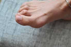 Image result for Hammer toe