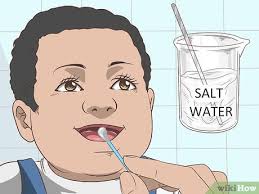 3 Formas De Eliminar A Candidiasis Bucal En Bebes