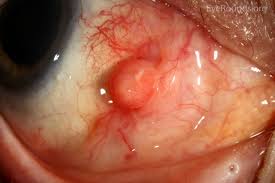 Image result for lesion sclera