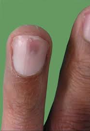 Image result for Glomus tumor