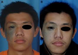 Comparing The Effectiveness Of Q Switched Ruby Laser Treatment With That Of Q Switched Nd Yag Laser For Oculodermal Melanosis Nevus Of Ota Sciencedirect