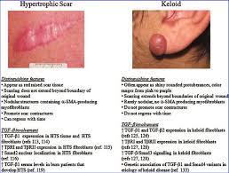 Although initially they may look similar, they are very different. Characteristics Of Human Hypertrophic Scars And Keloids A Download Scientific Diagram
