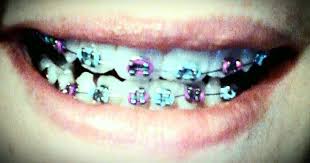 Blue And Purple Braces Good Colors Blue And Purple Purple Color